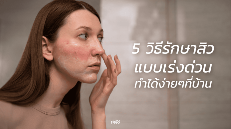 5 วิธีรักษาสิวแบบเร่งด่วน ทำได้ง่ายๆที่บ้าน